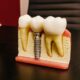 Transforming Smiles with Digital Dental Implants: Benefits and Advancements