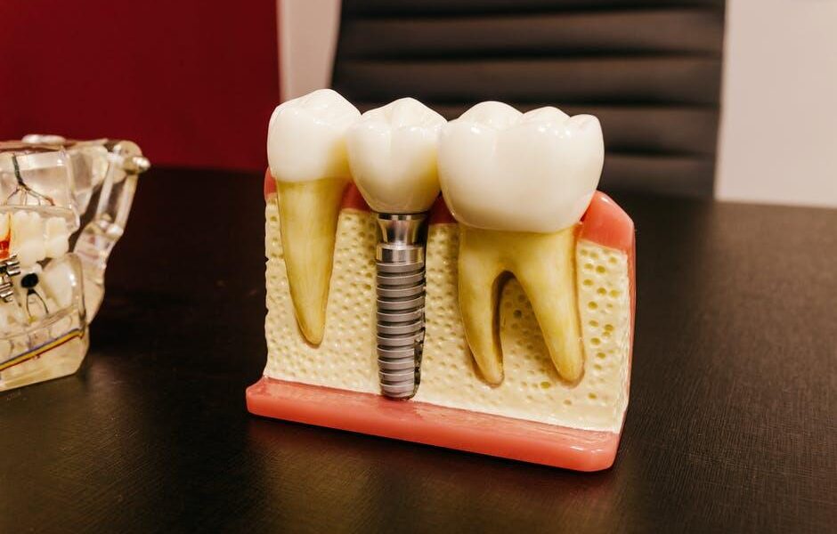 Transforming Smiles with Digital Dental Implants: Benefits and Advancements