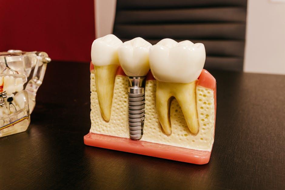 Transforming Smiles with Digital Dental Implants: Benefits and Advancements