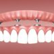 Tips for Finding the Most Affordable Dental Implants in Your Area