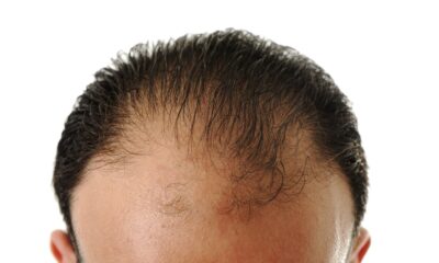 7 Things You Need to Know About PRF Hair Restoration