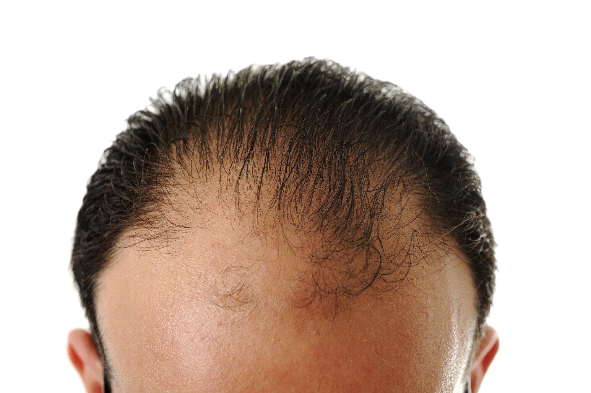 7 Things You Need to Know About PRF Hair Restoration