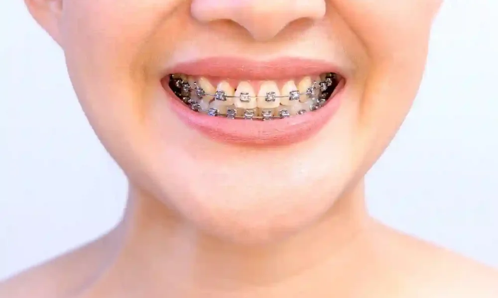 Understanding the Different Types of Teeth Braces and Their Role in Maintaining Straight Teeth