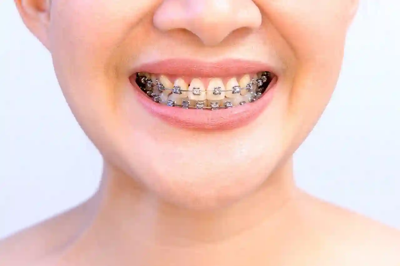 Understanding the Different Types of Teeth Braces and Their Role in Maintaining Straight Teeth