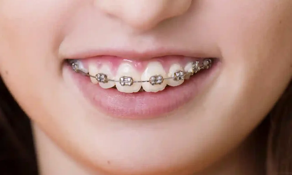 The Impact of Different Types of Braces on Oral Health