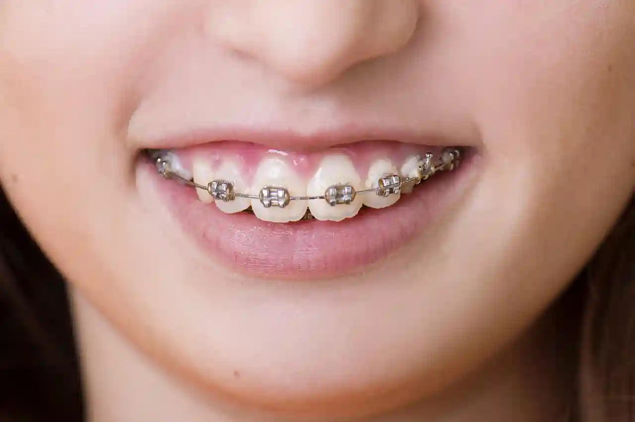 The Impact of Different Types of Braces on Oral Health