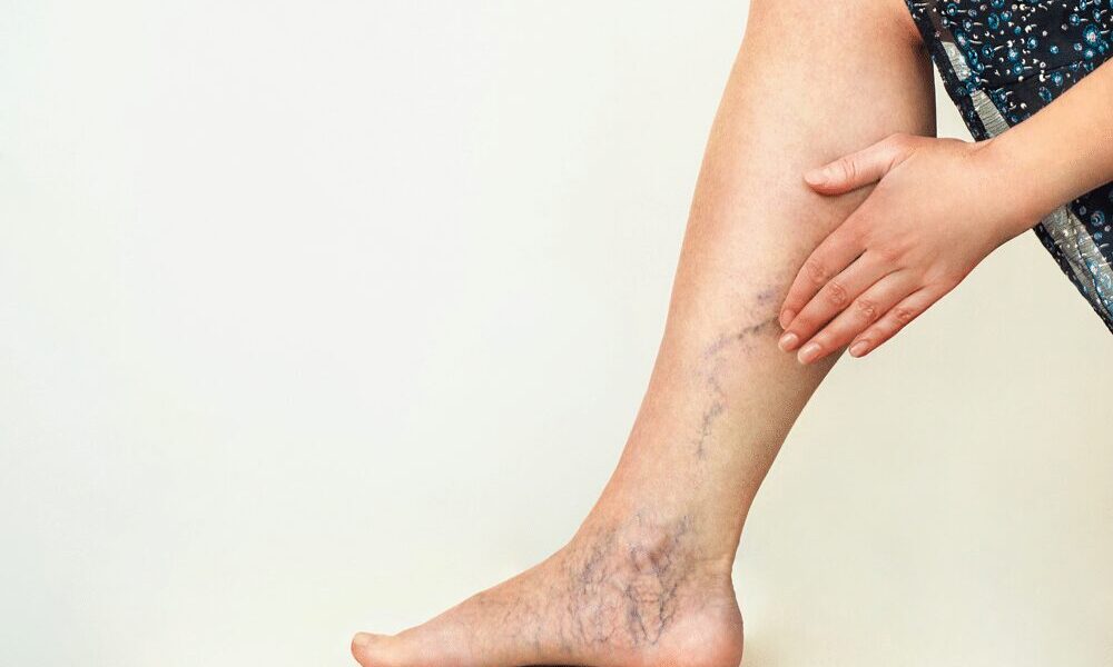 Understanding Sclerotherapy: A Comprehensive Guide