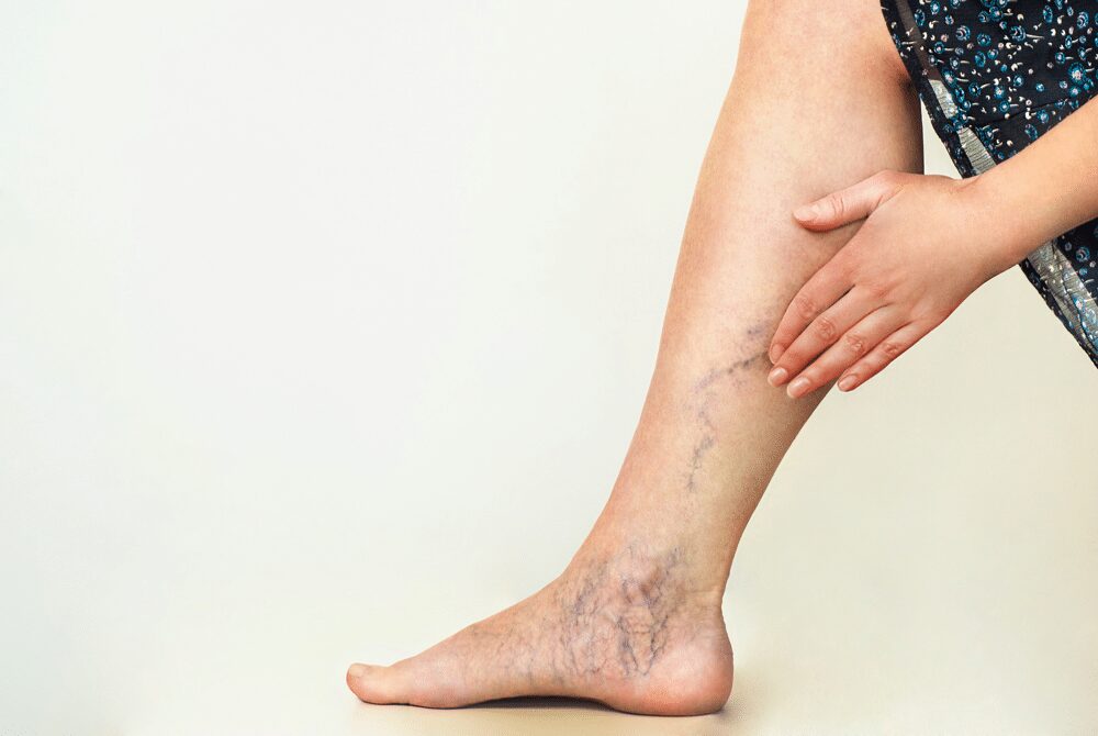 Understanding Sclerotherapy: A Comprehensive Guide